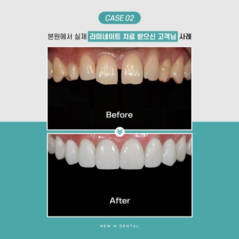 강남라미네이트 잘하는 곳 뉴엔치과 관련 이미지 9