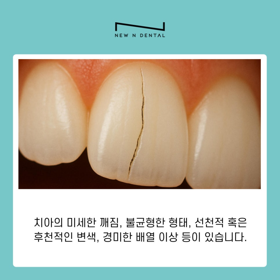 서초 라미네이트 심미를 완성하는 보철 치료의 원리와 기준 관련 이미지 5