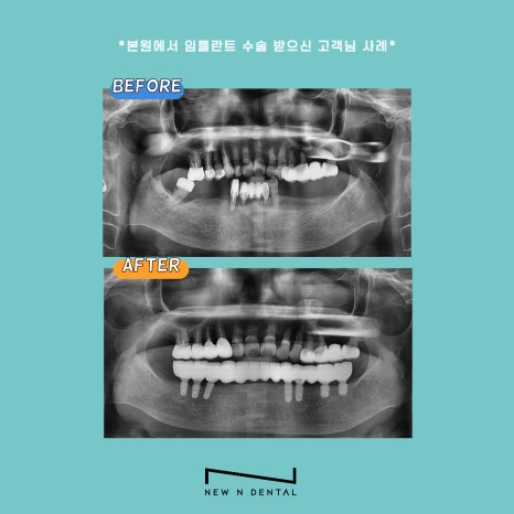신논현역임플란트 건강하고 오래쓰는 임플란트 관련 이미지 8