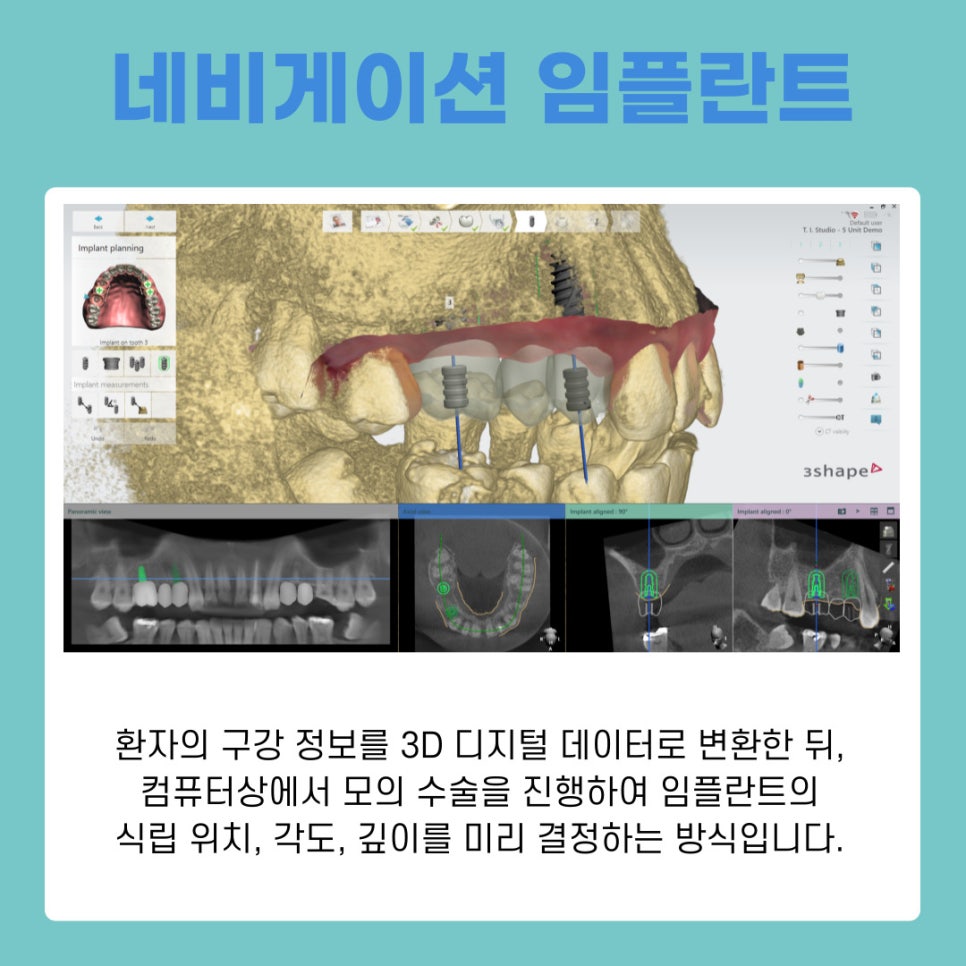 서초 임플란트치과 통증은 줄이고 정확도는 높이는 네비게이션 치료법 관련 이미지 6