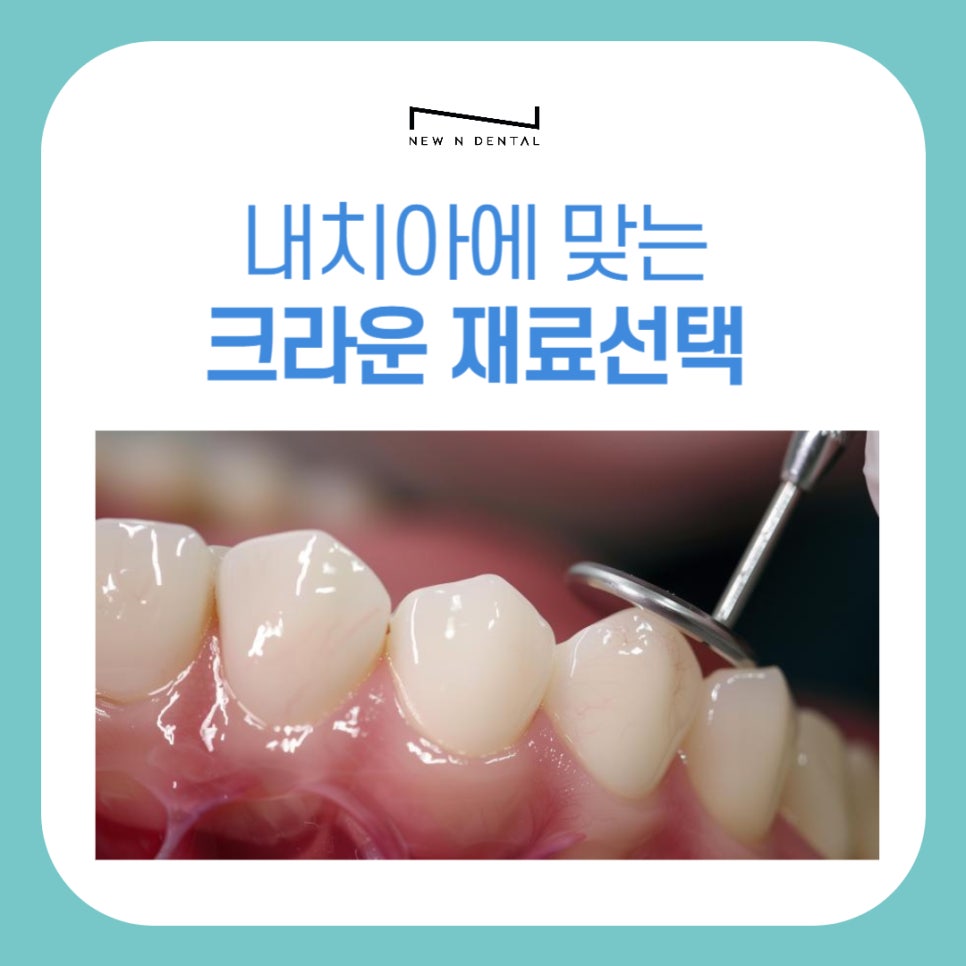 치아 지르코니아 크라운 중요한 요소 관련 이미지 3