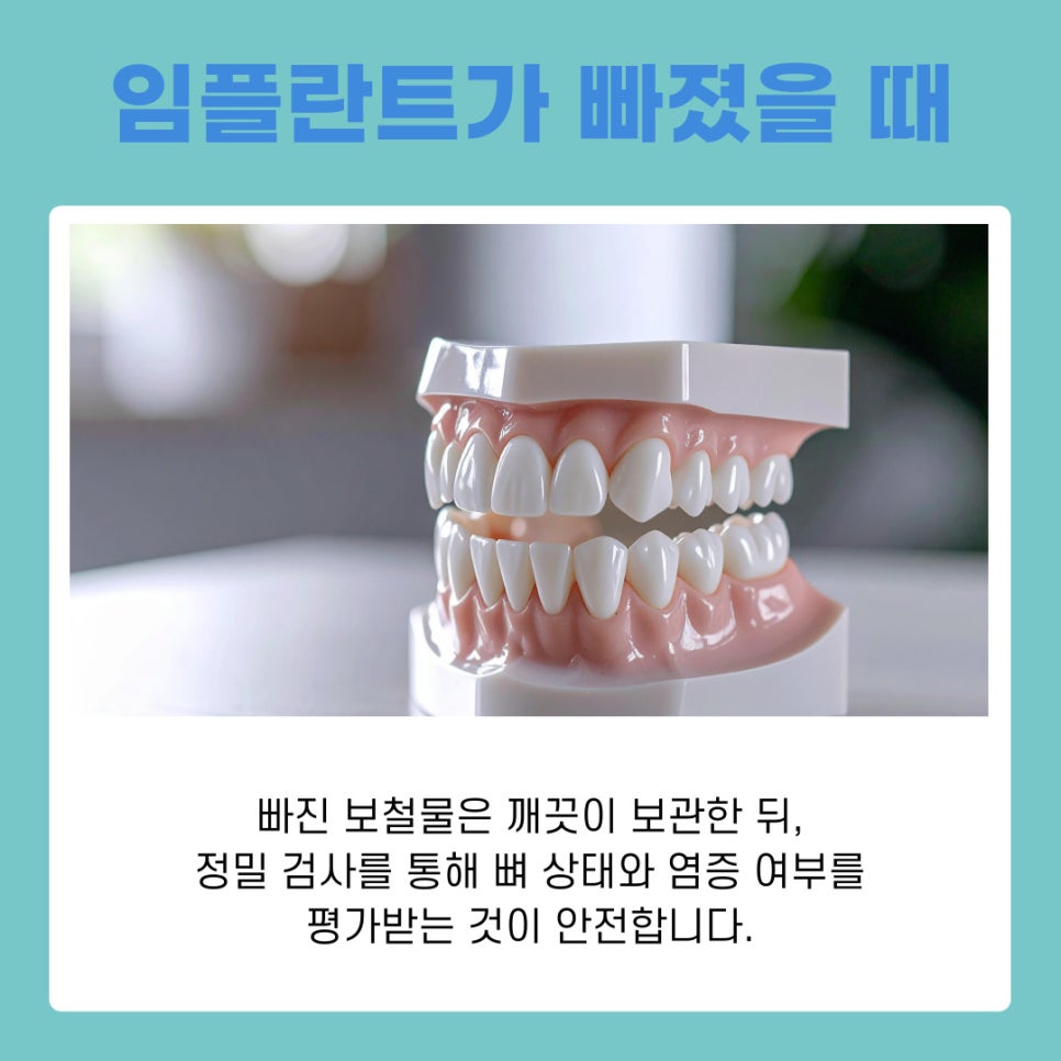 강남논현동치과 임플란트 빠짐 원인과 재치료 가능성 정리 관련 이미지 8
