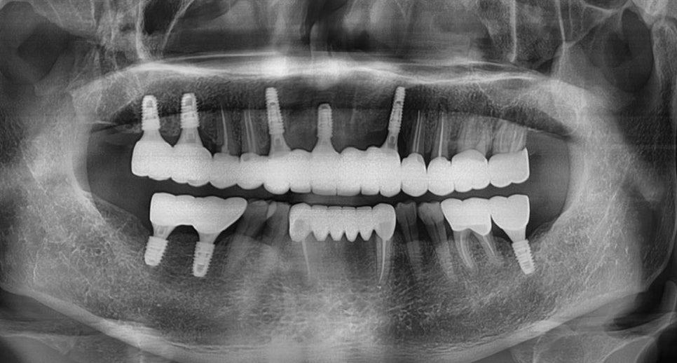 논현동임플란트치과 경험이 풍부한 곳 관련 이미지 5