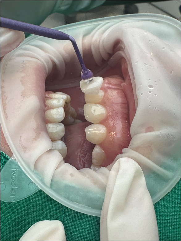 강남구라미네이트치과 튼튼하고 정교하게 관련 이미지 7