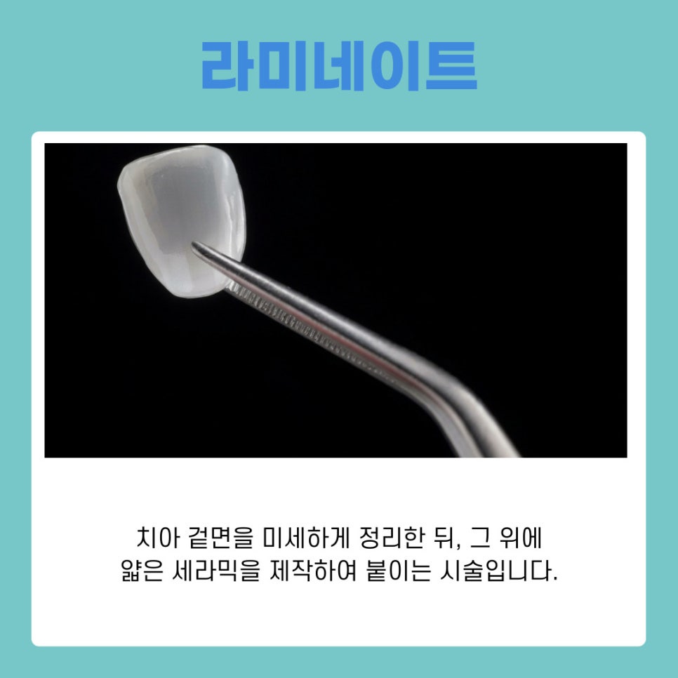 서초구치과에서 벌어진 앞니 교정 나에게 맞는 치료 알아보기 관련 이미지 6