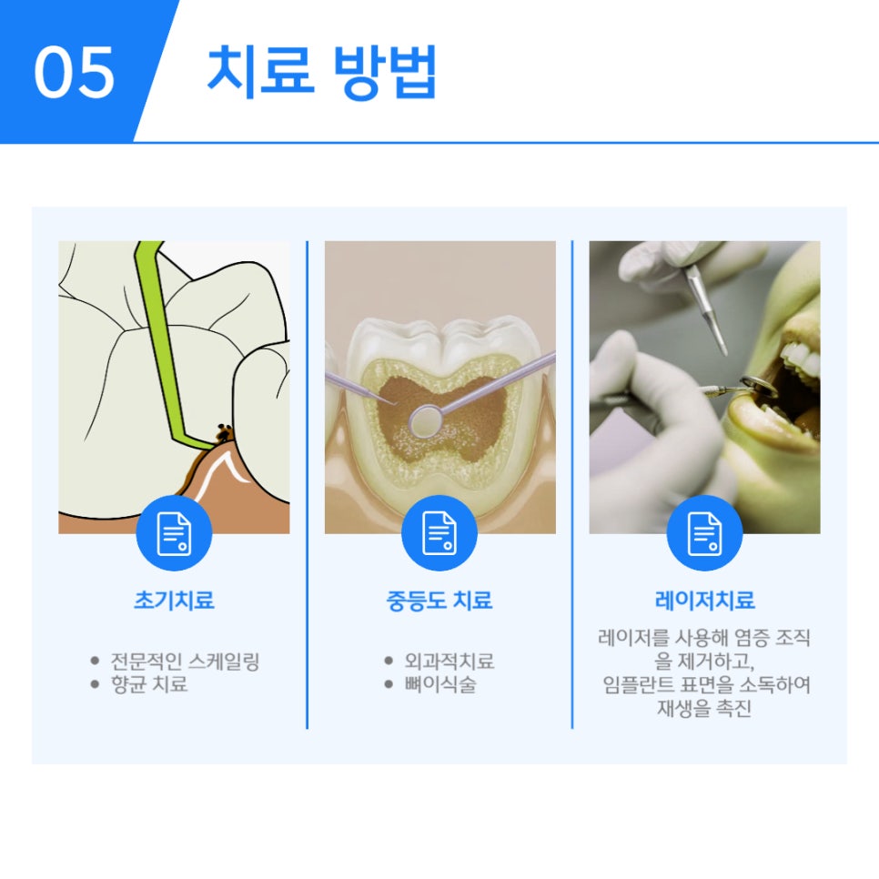 임플란트 주위염 원인과 예방방법 관련 이미지 6