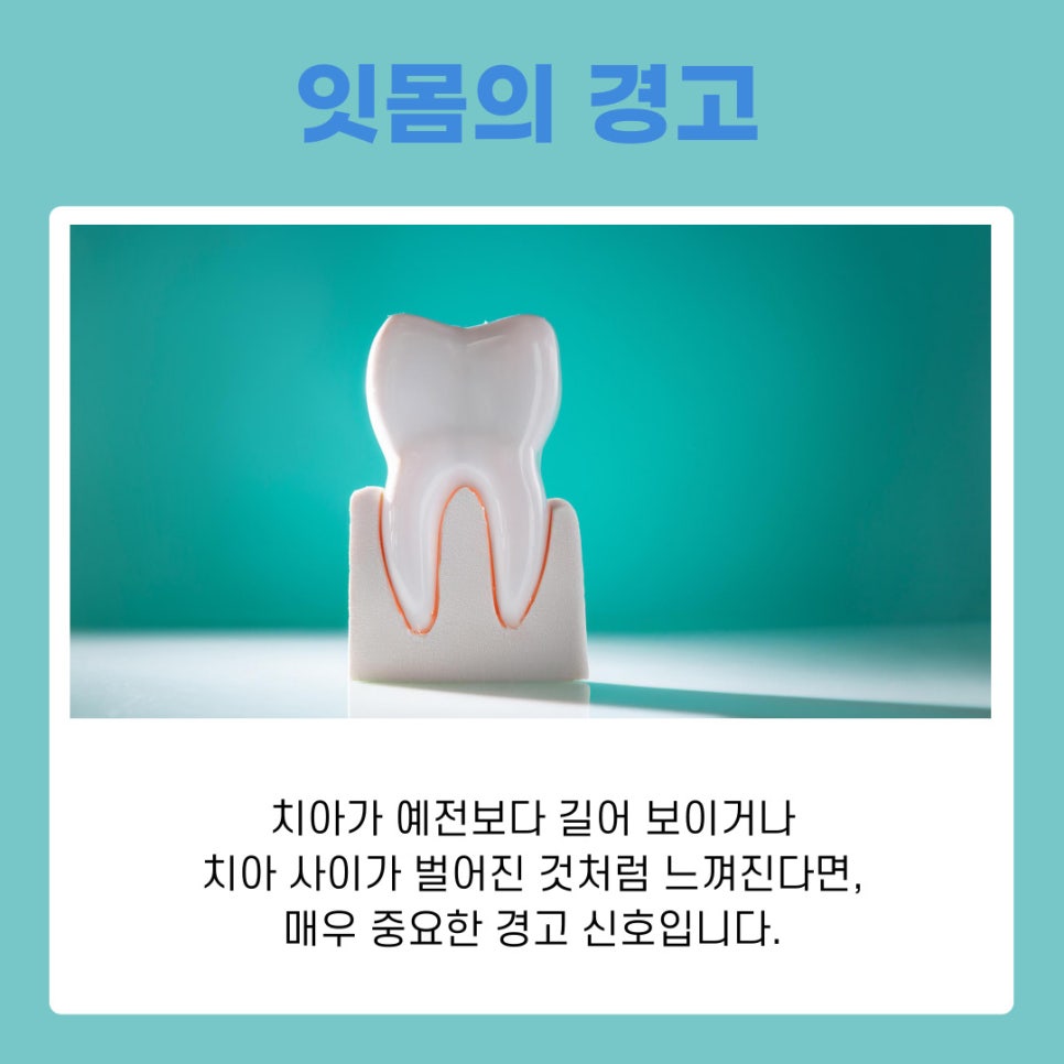 풍치증상 처음 나타나는 신호는 무엇일까 관련 이미지 7