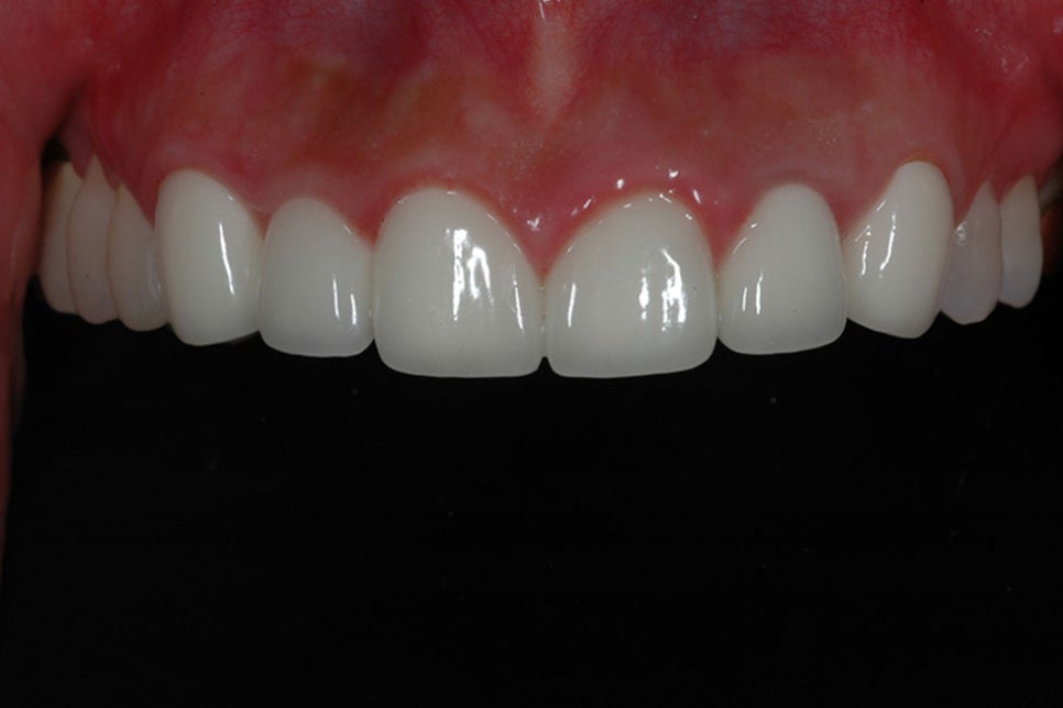 논현동라미네이트 인상이 좋아 보이도록 관련 이미지 6