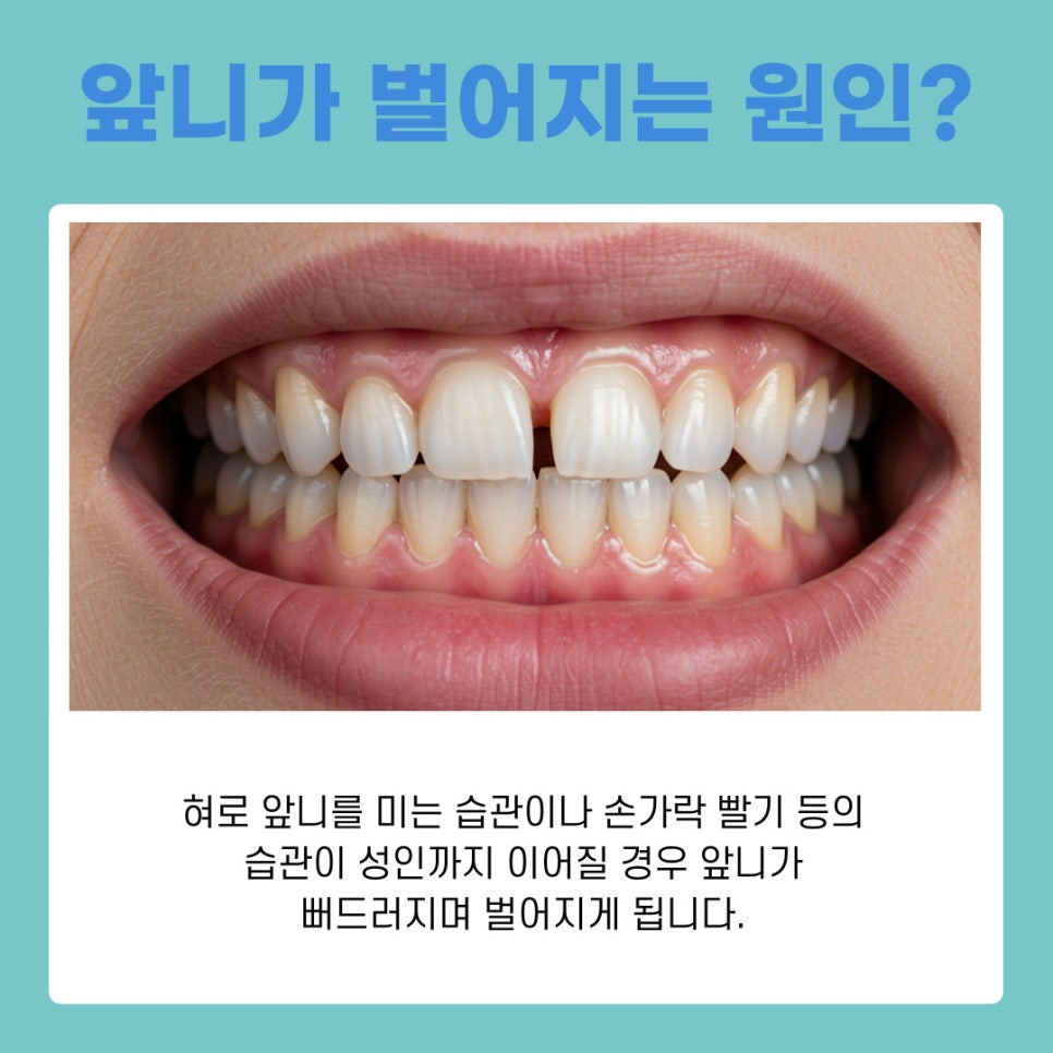 서초구치과에서 벌어진 앞니 교정 나에게 맞는 치료 알아보기 관련 이미지 3