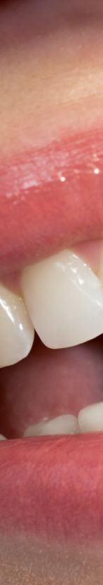 강남 무삭제라미네이트 치아깎지않는 개선방법 관련 이미지 11