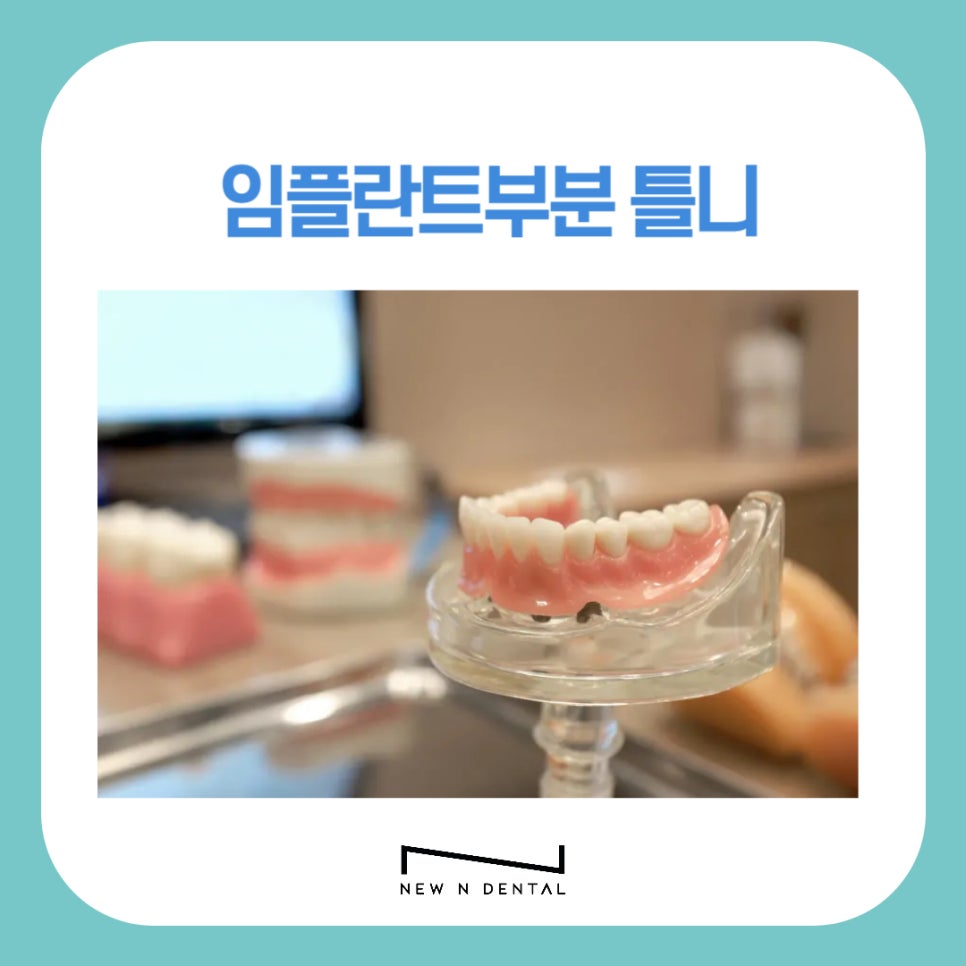 임플란트부분틀니 장단점과 치료방법은 관련 이미지 1