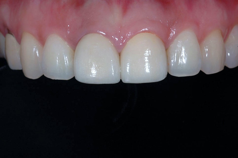 강남구라미네이트치과 튼튼하고 정교하게 관련 이미지 5