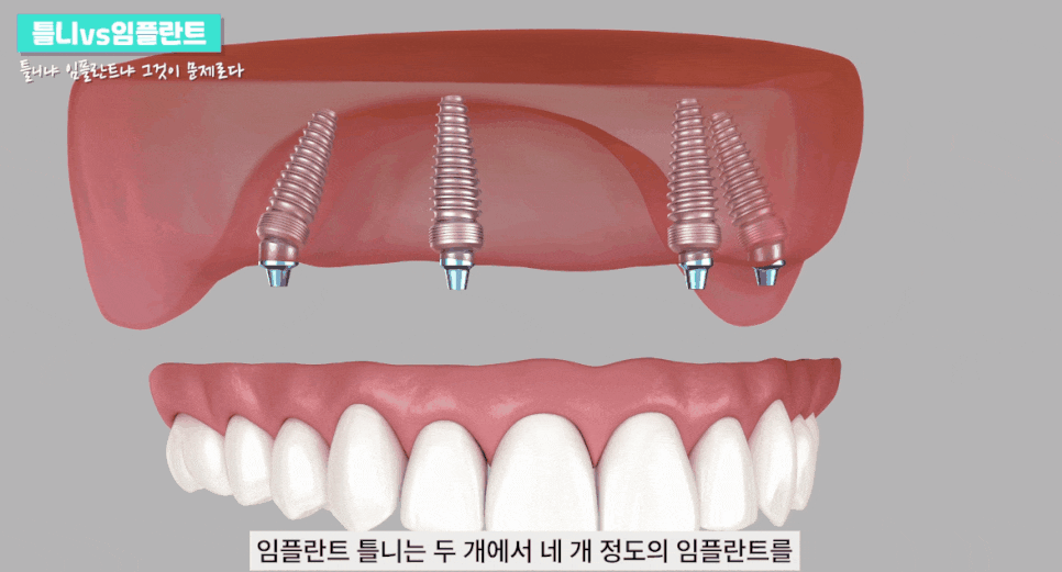 신논현역임플란트 건강하고 오래쓰는 임플란트 관련 이미지 4