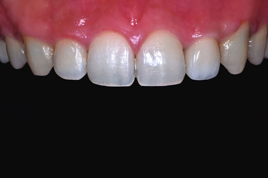 강남구치과추천 티없는 치아의 자신감 관련 이미지 5