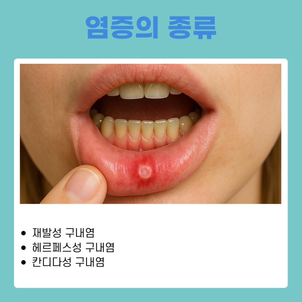 The Cause of Stomatitis: The Unwelcome Guest in Your Mouth Brought on by Fatigue and Nutritional Imbalance image 7