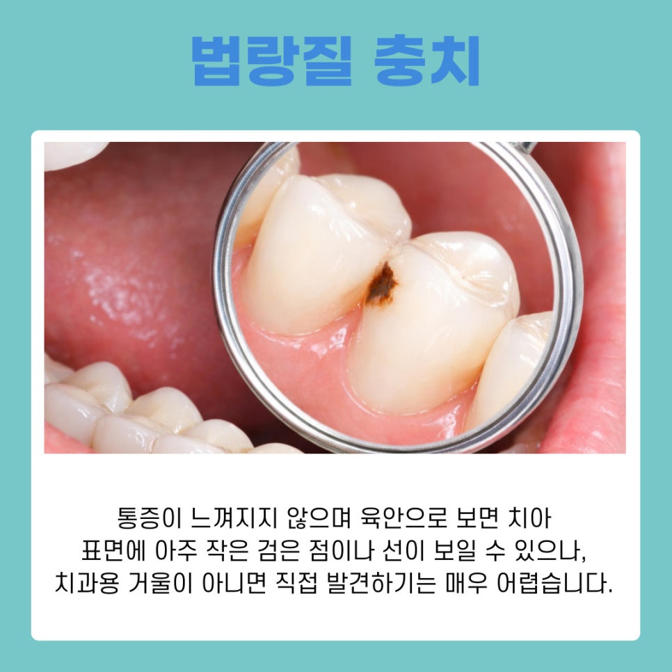 치과 가기 전 확인하세요 충치 단계별 치료 가이드 관련 이미지 6