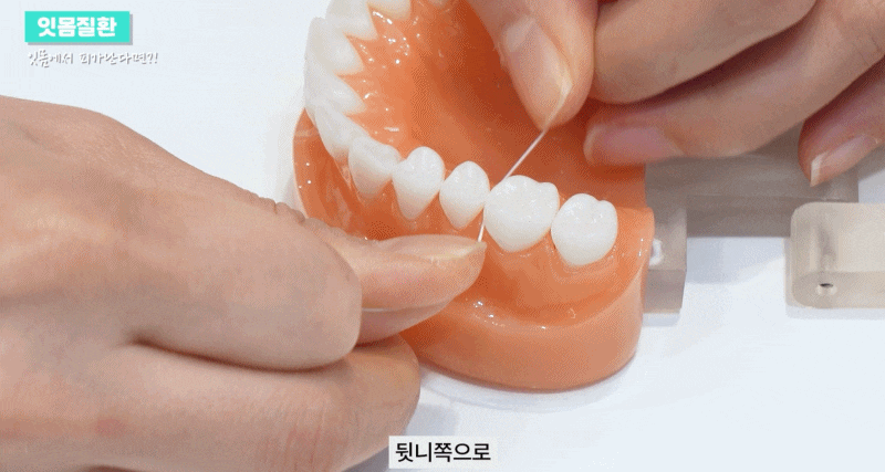 잇몸질환의 종류 출혈이 있을 때 예방방법 관련 이미지 15