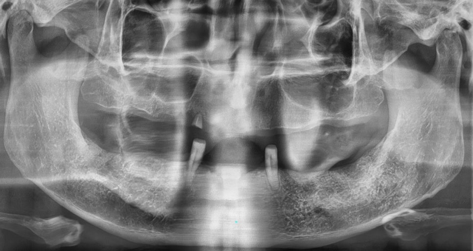 서초동임플란트치과 자연 치아가 탈락했다면 관련 이미지 6