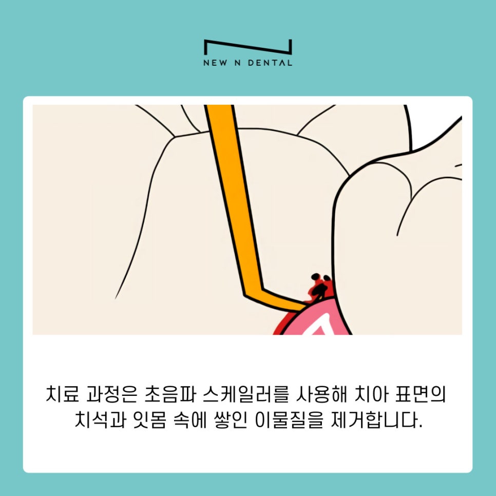 강남역치과 풍치치료법 스케일링으로 잇몸건강 되찾는 법 관련 이미지 6
