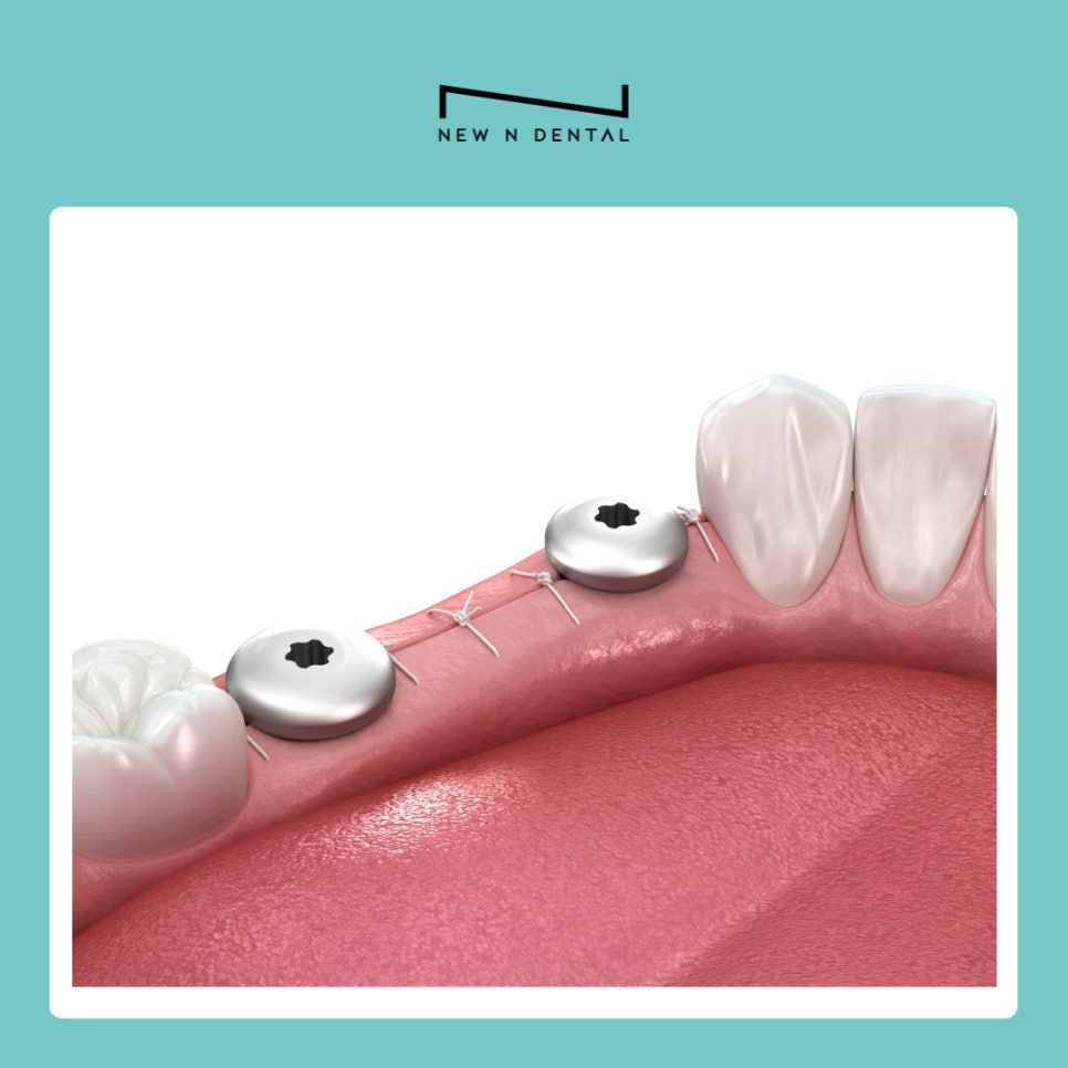 서초동임플란트치과와 함께하는 건강한 치아 회복과 관리 가이드 관련 이미지 5