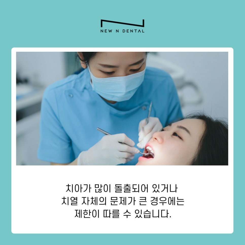 라미네이트 치아삭제 없이도 가능한 치아성형 알아보기 관련 이미지 5