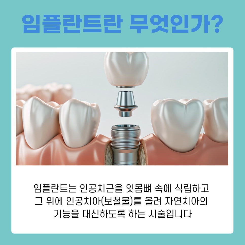 A Complete Guide to Implant Steps and Differences by Type at a Gangnam Station Dental Clinic image 3