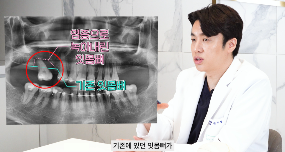 논현역치과 상악동거상술 어떤 치료일까 관련 이미지 6