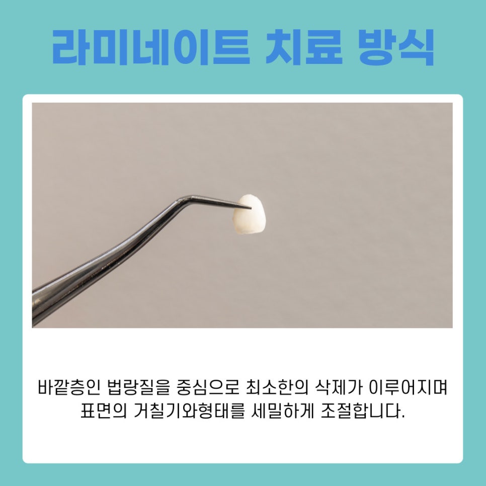 서초 라미네이트 심미를 완성하는 보철 치료의 원리와 기준 관련 이미지 4