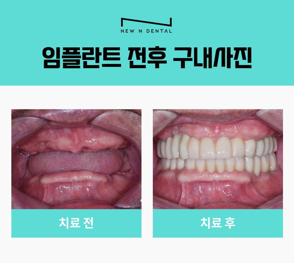 서초동임플란트치과 자연 치아가 탈락했다면 관련 이미지 10