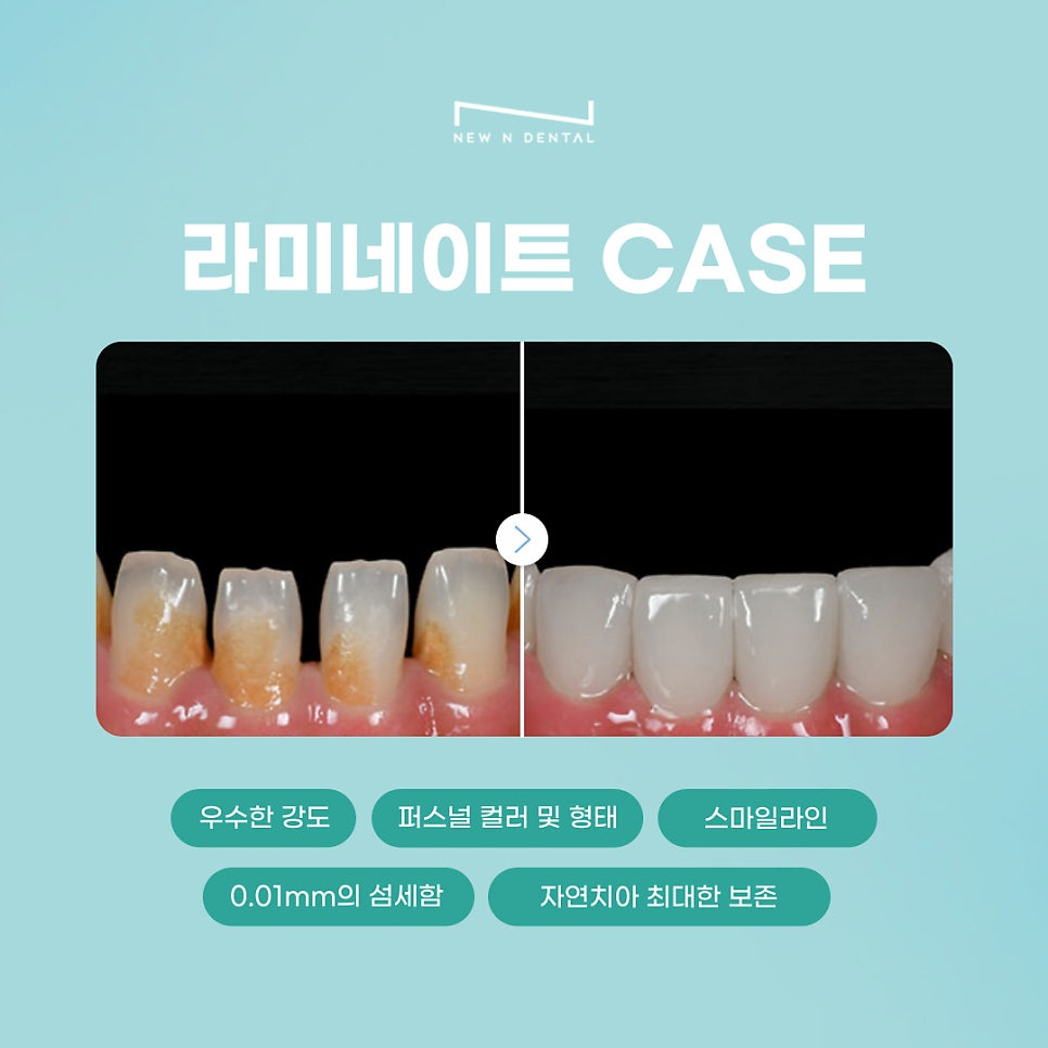 뉴엔치과만의 특별함, 퍼스널라미 관련 이미지 9