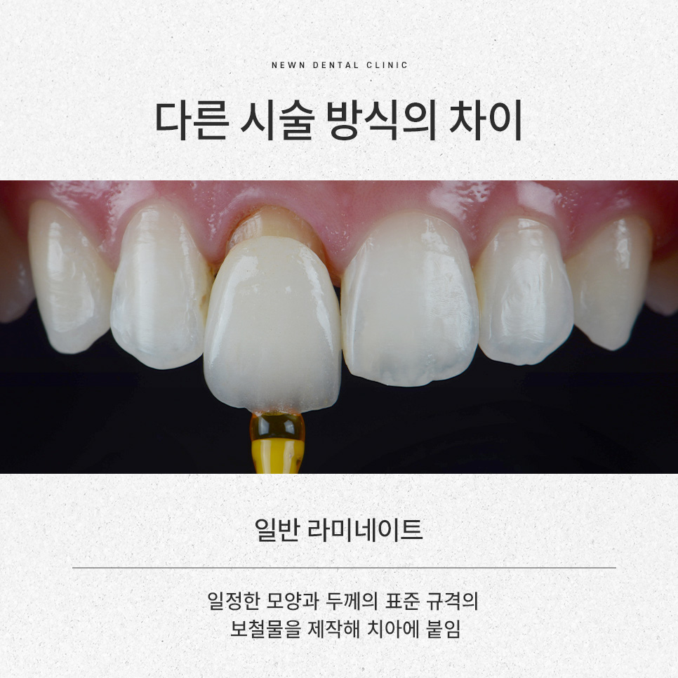 강남역 뉴엔치과 일반 라미네이트와 퍼스널라미의 차이점 관련 이미지 8