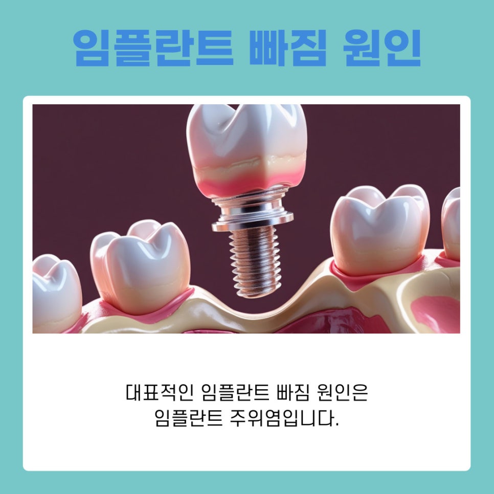강남논현동치과 임플란트 빠짐 원인과 재치료 가능성 정리 관련 이미지 4