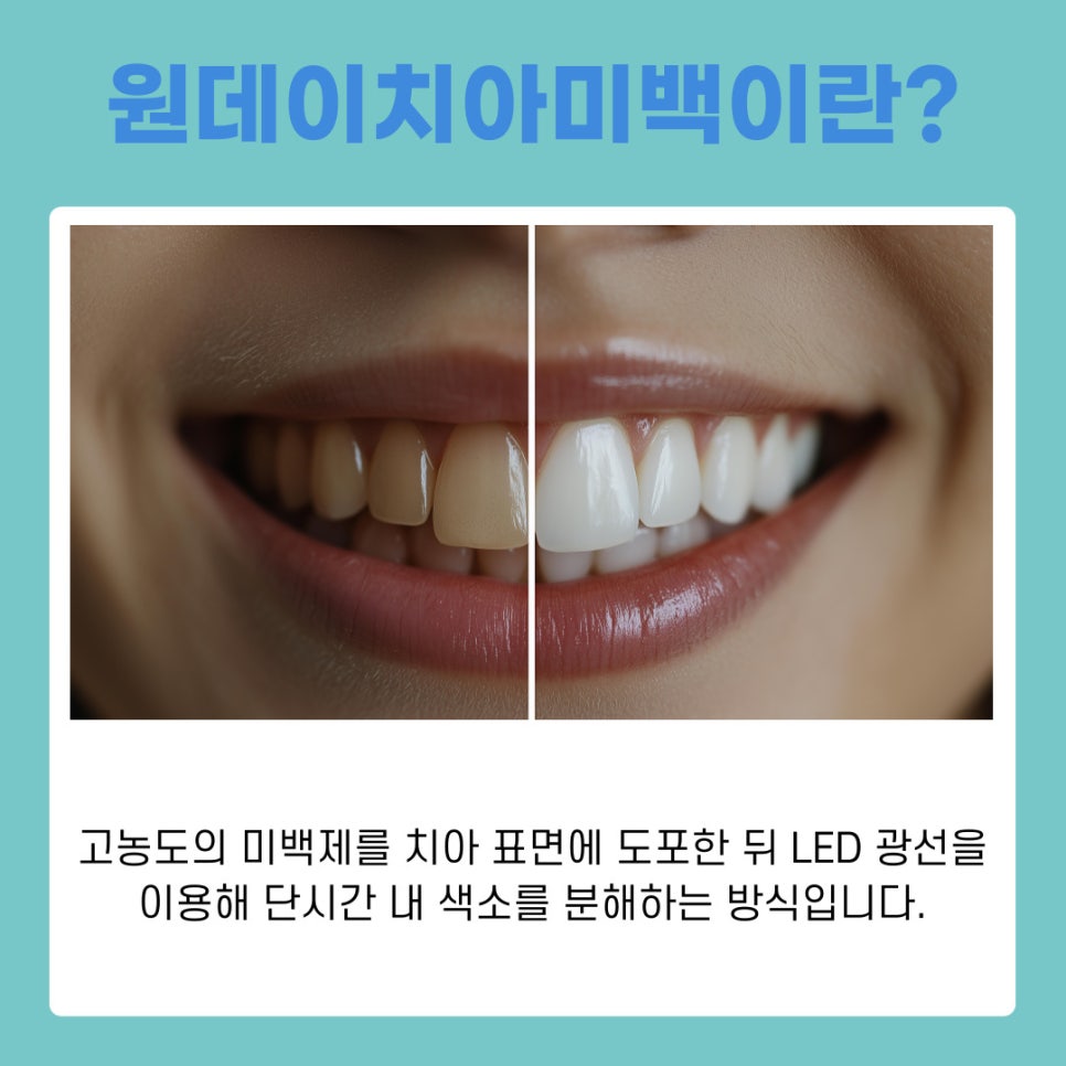 강남역치과추천 시간 없는 직장인도 가능한 원데이치아미백 관련 이미지 3