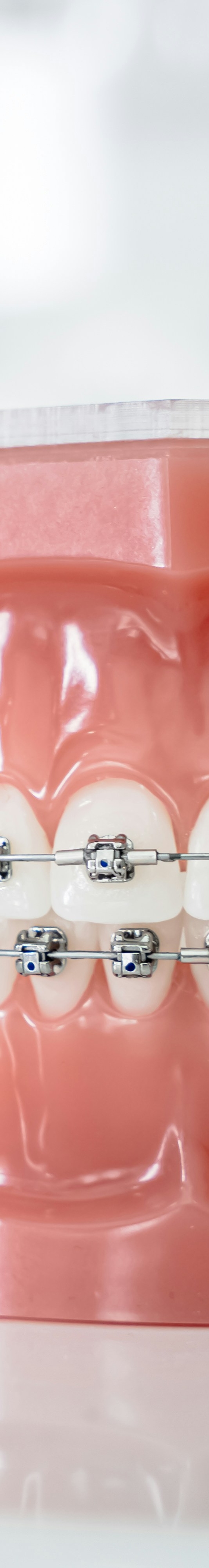 치아교정 종류 장단점 알아보기 관련 이미지 15