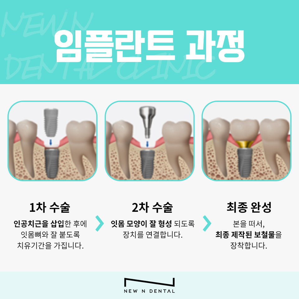 역삼동임플란트추천 치아를 건강하게 관련 이미지 7