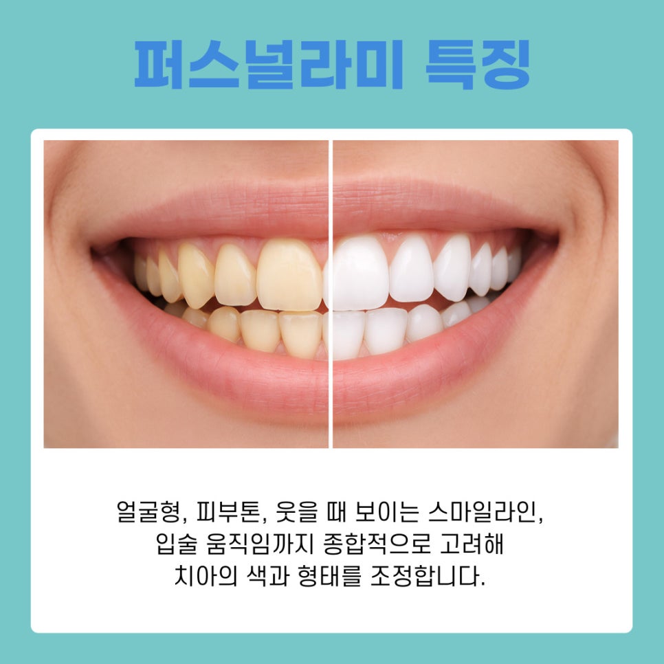 무삭제 퍼스널라미 개인 맞춤형 치아성형 관련 이미지 3