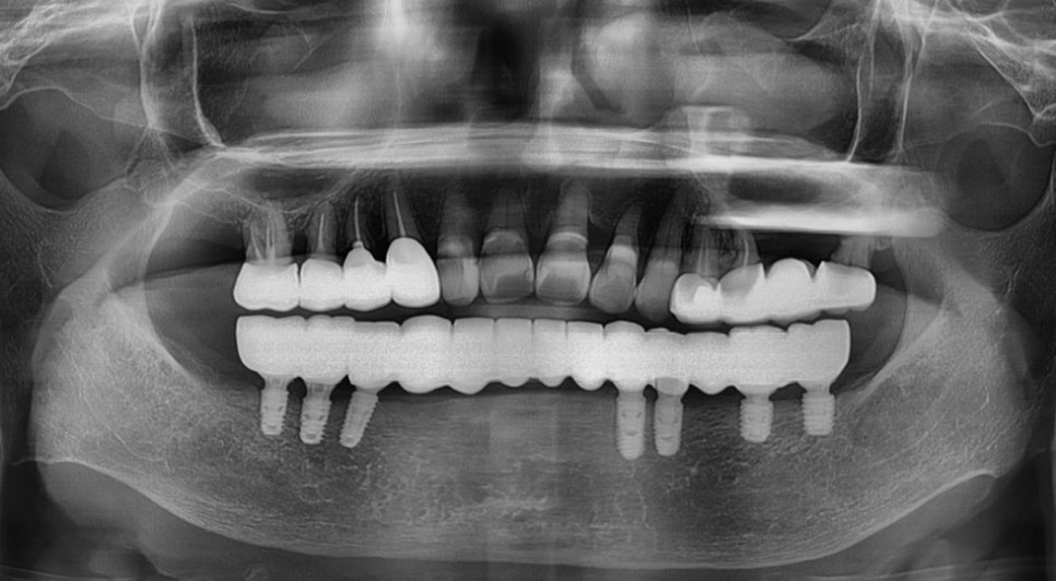 강남임플란트잘하는치과 찾는다면 관련 이미지 9