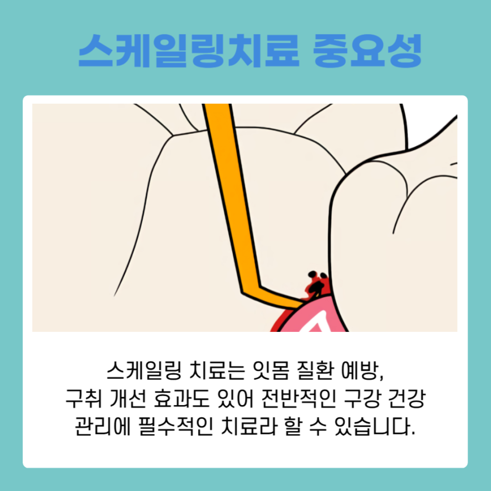 치아변색원인과 스케일링치료로 개선하는 방법 관련 이미지 6