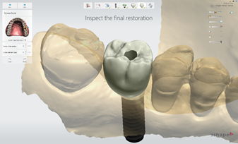 서초임플란트 경험과 디지털로 명확하게 관련 이미지 6