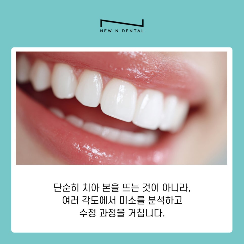 무삭제 퍼스널라미 개인 맞춤형 치아성형 관련 이미지 4