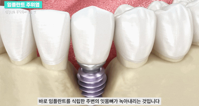 Gangnam Peri-Implantitis: Causes, Symptoms, and Prevention image 9