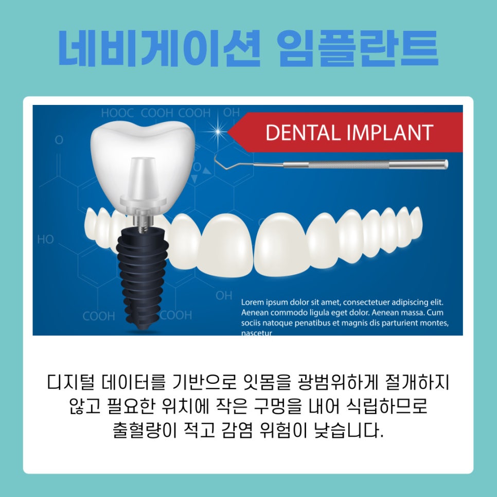 서초동임플란트치과와 함께하는 건강한 치아 회복과 관리 가이드 관련 이미지 8