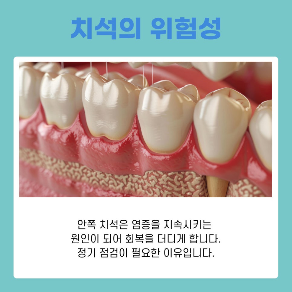 강남 논현동 치과 치석관리 소홀하면 생길 수 있는 위험 관련 이미지 5