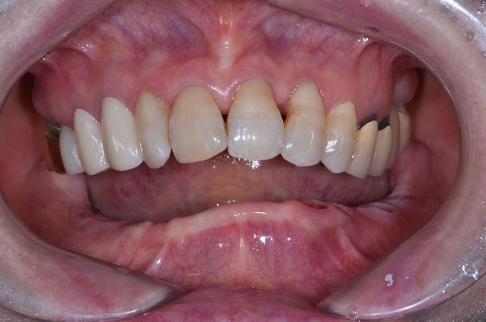 강남임플란트잘하는치과 찾는다면 관련 이미지 6