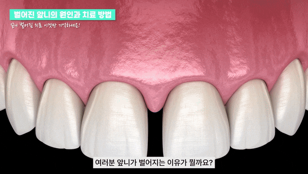 신논현치과 치아 삭제 없이 깔끔한 미소 관련 이미지 3