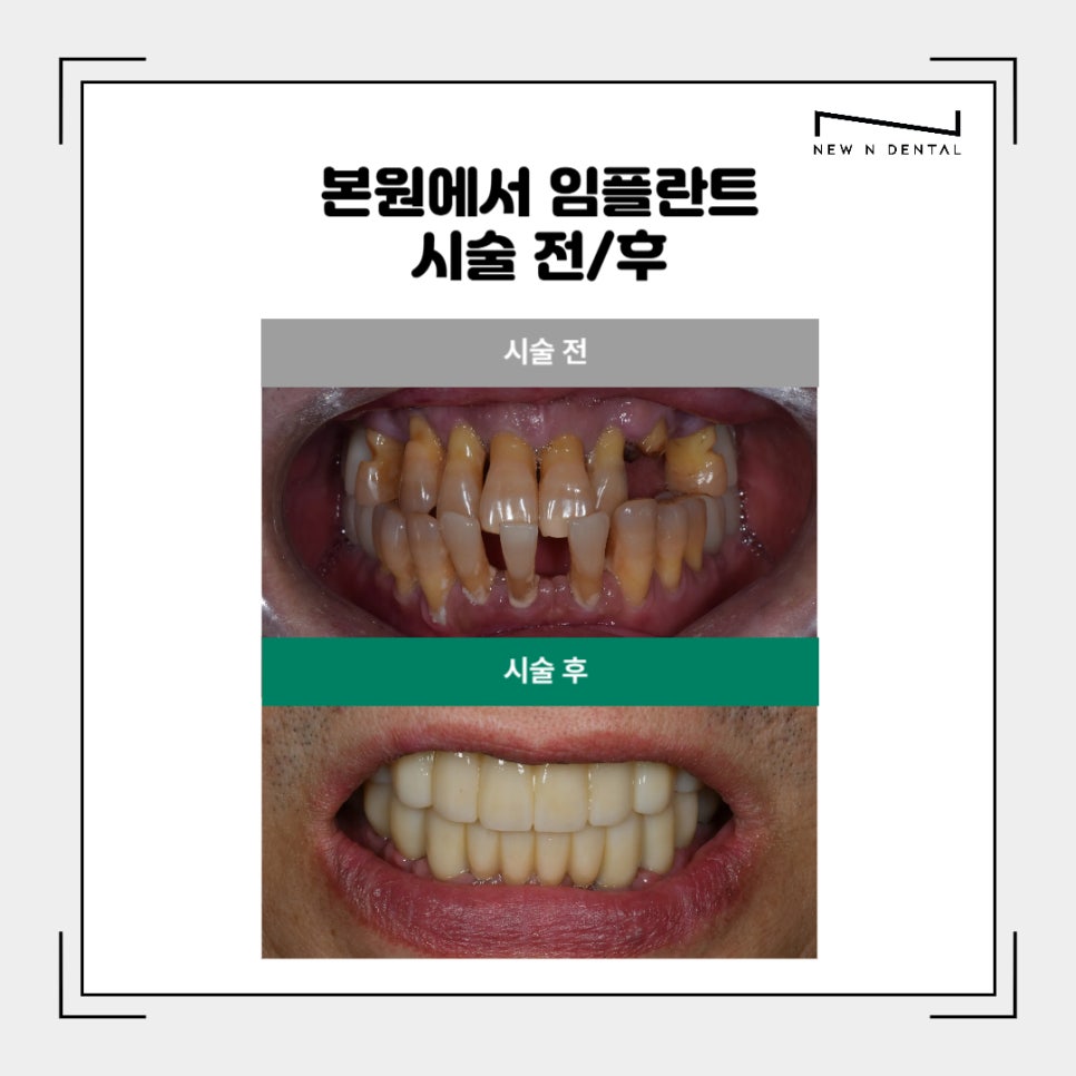 강남임플란트치과 치료부터 뼈이식까지 관련 이미지 8
