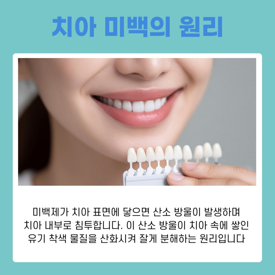 치과 치아미백의 원리부터 종류별 특징까지 완벽 가이드 관련 이미지 4