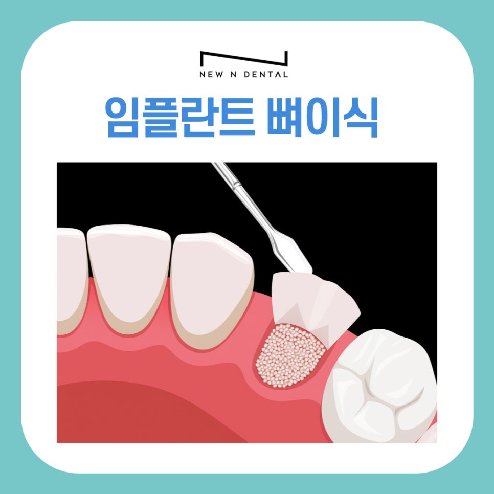 강남 역삼동 임플란트 뼈이식 과정과 회복 기간 이것만 알면 끝 관련 이미지 2