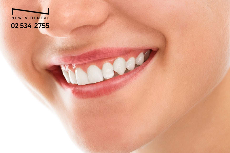 강남역라미네이트 환한 인상을 위한 관리 관련 이미지 4