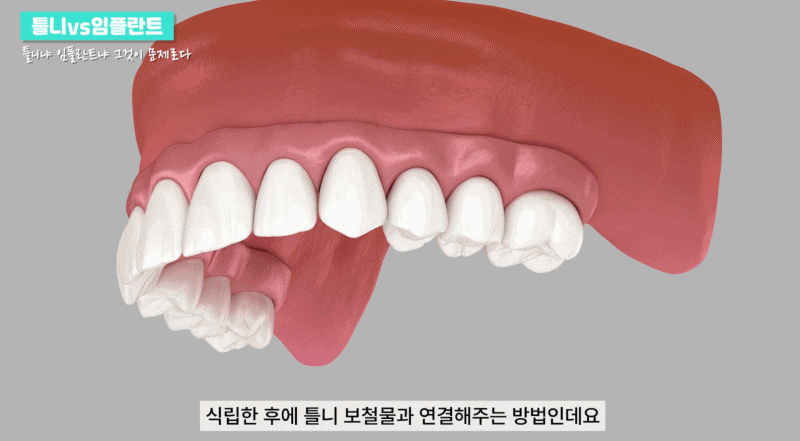 임플란트부분틀니 장단점과 치료방법은 관련 이미지 6